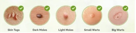 skin tags pictures - Skin Tag Remover | Can You Remove A Skin Tag Yourself?