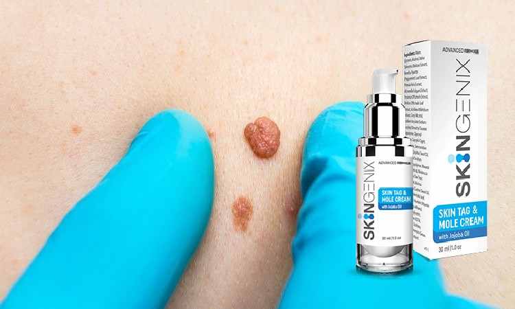 Skingenix Reviews – Skin Tags and Mole Removal