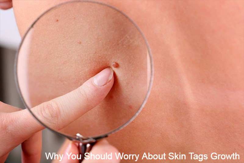 Cancerous Skin Tags : Why You Should Worry About Skin Tags Growth