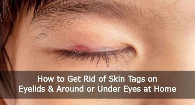 Skin Tags On Eyelids Removal