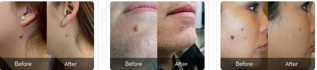 Skin Tag Removal Before And After Pictures - Shark Tank Skin Tag Removal Episode